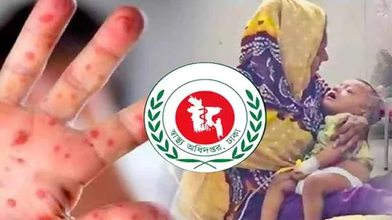 হাম উপসর্গে আরও ৯ শিশুর মৃত্যু