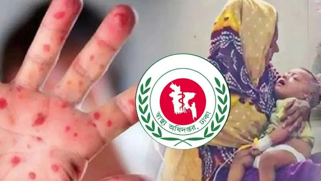 হাম উপসর্গে আরও ৩ শিশুর মৃত্যু, আক্রান্ত ৩০৬১