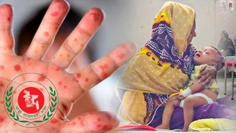 হামের উপসর্গ নিয়ে আরও ৩ মৃত্যু, আক্রান্ত ১৩৪৯