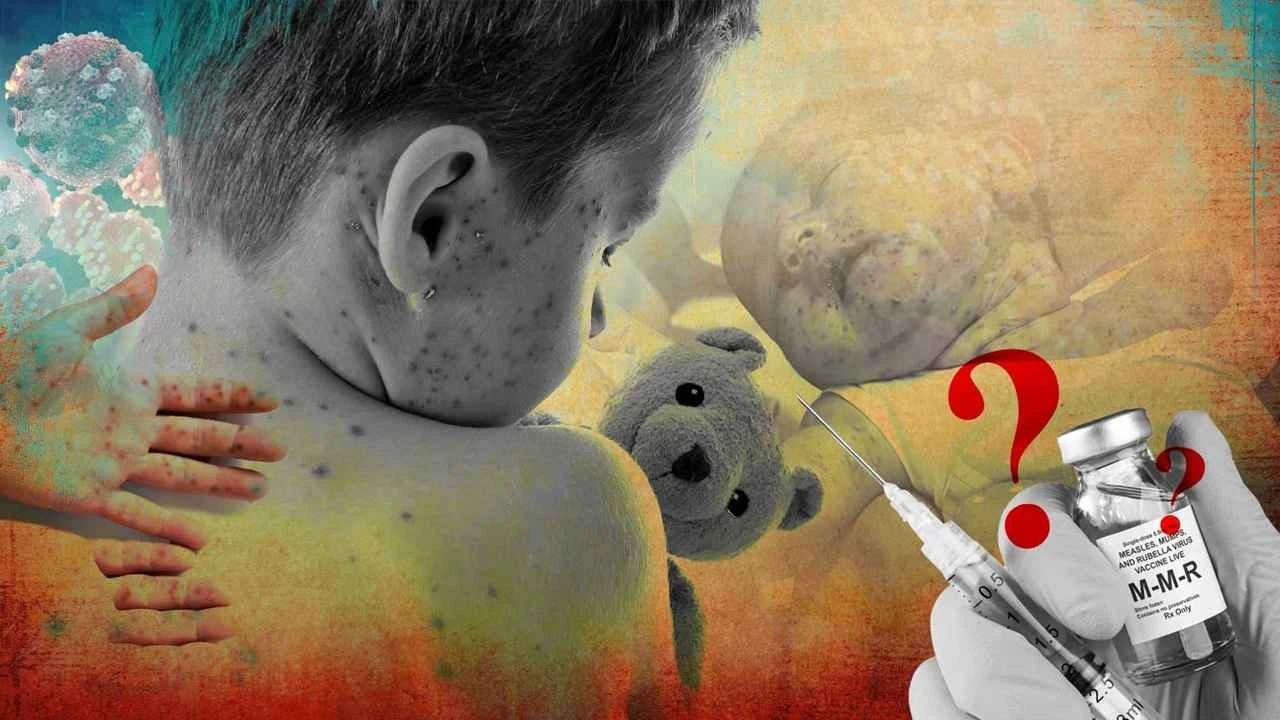 হাম ও উপসর্গে মৃত্যুর সংখ্যা বেড়ে ৭৫০