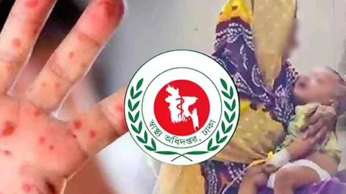 হাম ও উপসর্গে আরও ৫ শিশুর মৃত্যু