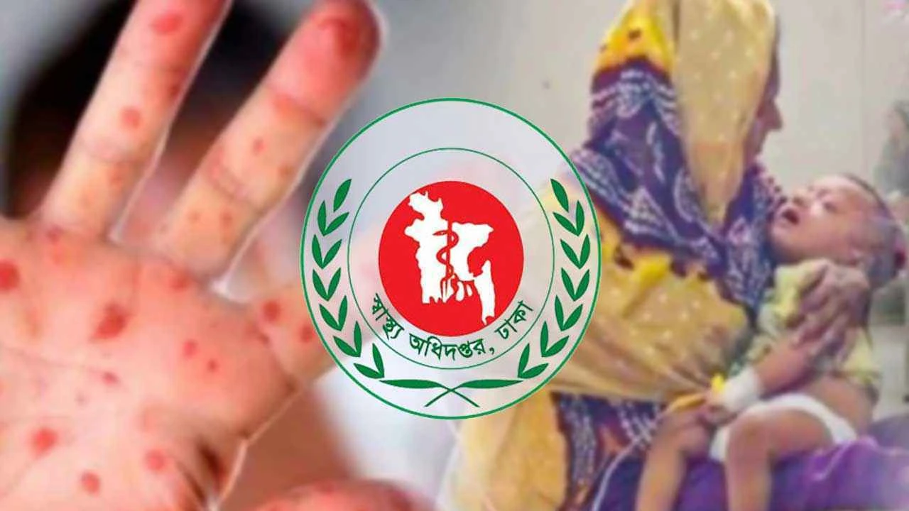 হাম উপসর্গে আরও ৭ শিশুর মৃত্যু, নতুন আক্রান্ত ১১৯৪