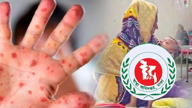 হাম উপসর্গে আরও ৪ জনের মৃত্যু