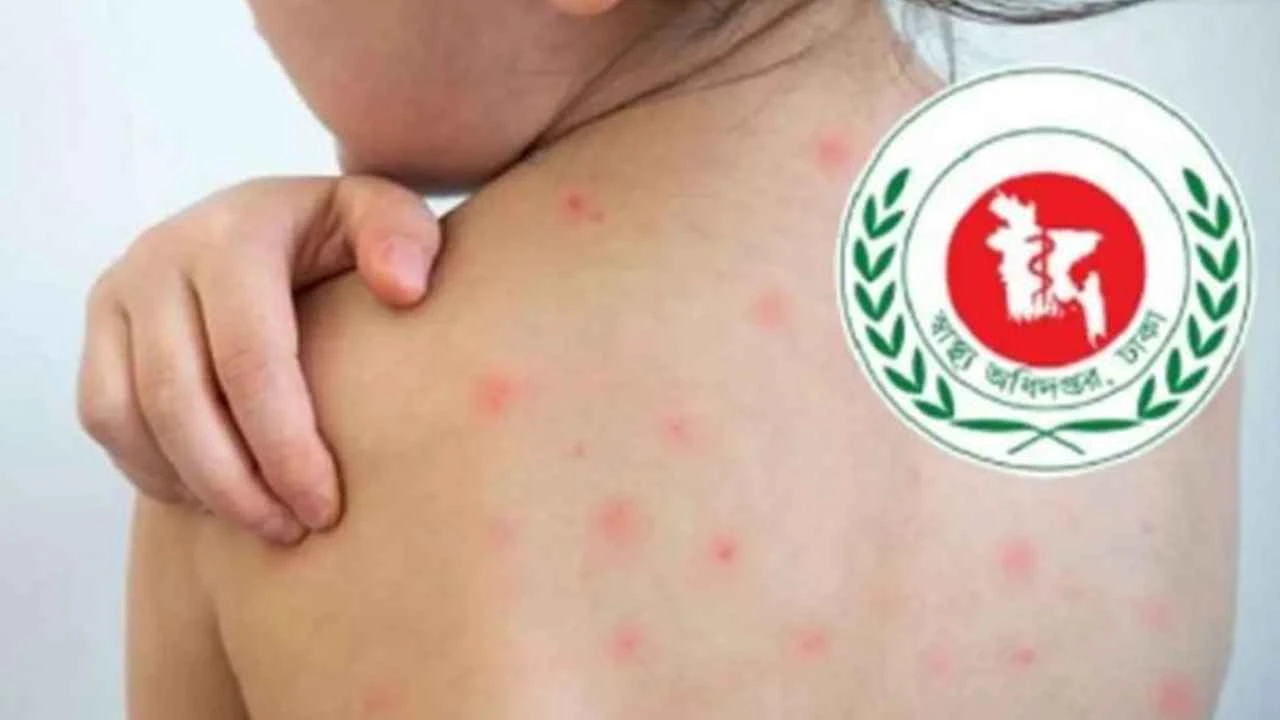 উপসর্গ ও হামে মোট মৃত্যু ১১০০ ছাড়াল
