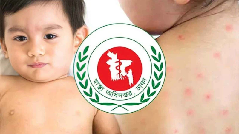 হাম উপসর্গে আরও ২ শিশুর মৃত্যু
